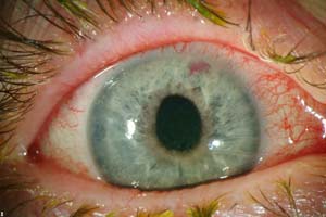 آب‌ سیاه‌ چشم‌، نوع‌ زاویه‌ بسته‌ اولیه‌ 