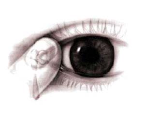 آب‌ سیاه‌ چشم‌، نوع‌ مزمن‌ زاویه‌ باز 