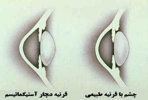 آستیگماتیسم 